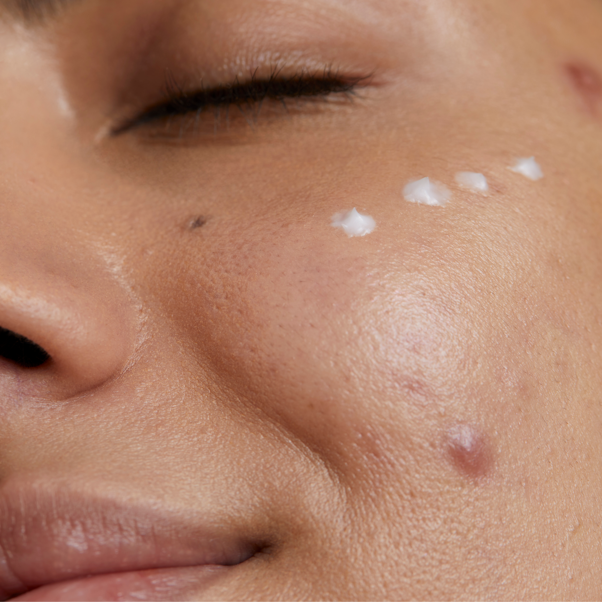 crema facial para cicatrices atróficas